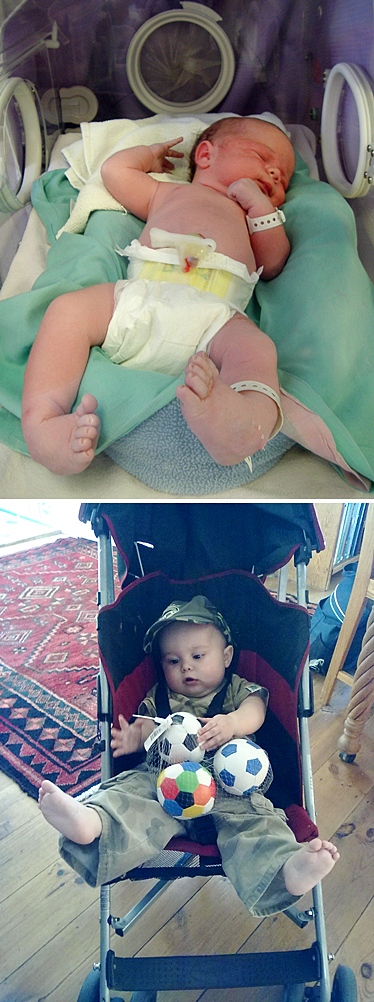 clubfoot before and after